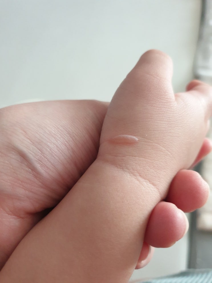  우리 아기가 화상으로 물집이 생겼어요! 화상 물집, 소아과에서 진료받은 후기.(ft.물집 터트리기, 치료 기간, 현재 상태)