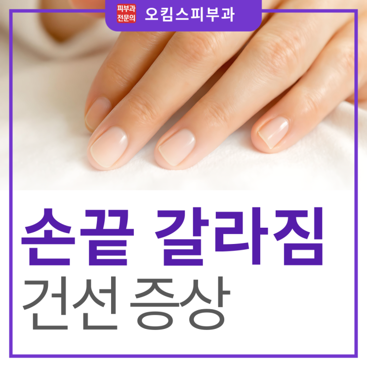  일산건선피부과 겨울 손끝 갈라짐, 혹시 건선 증상일까?