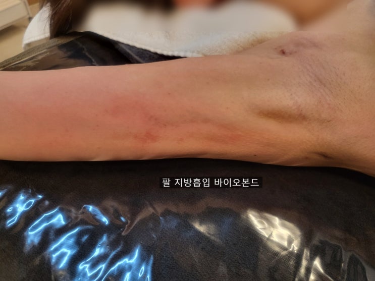  팔 지방흡입 바이오본드, 2주차 관리 후 변화 후기