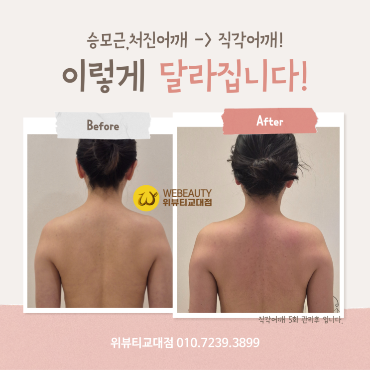  웨딩 관리 필수! 말린 어깨와 넓은 등 관리/위뷰티 교대점 에스테틱에서 직각어깨 완성