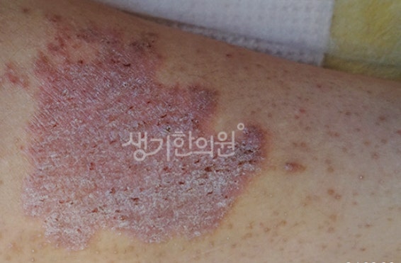 성인 엉덩이골 습진 연고를 발라도 낫지 않는 이유
