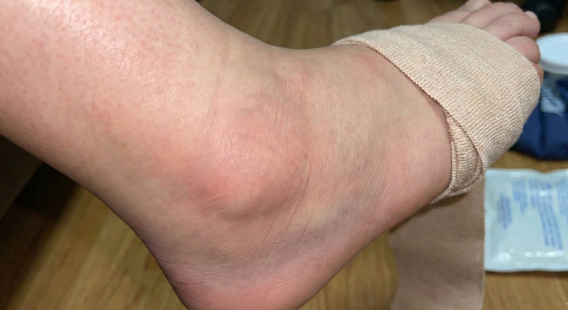 아침마다 붓는 얼굴, 저녁엔 꽉 끼는 신발 [부종(Edema)]의 원인과 근본 치료