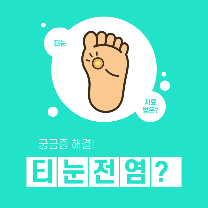 티눈 전염, 정말 다른 사람에게 옮을까요? 궁금증 완벽 해결!