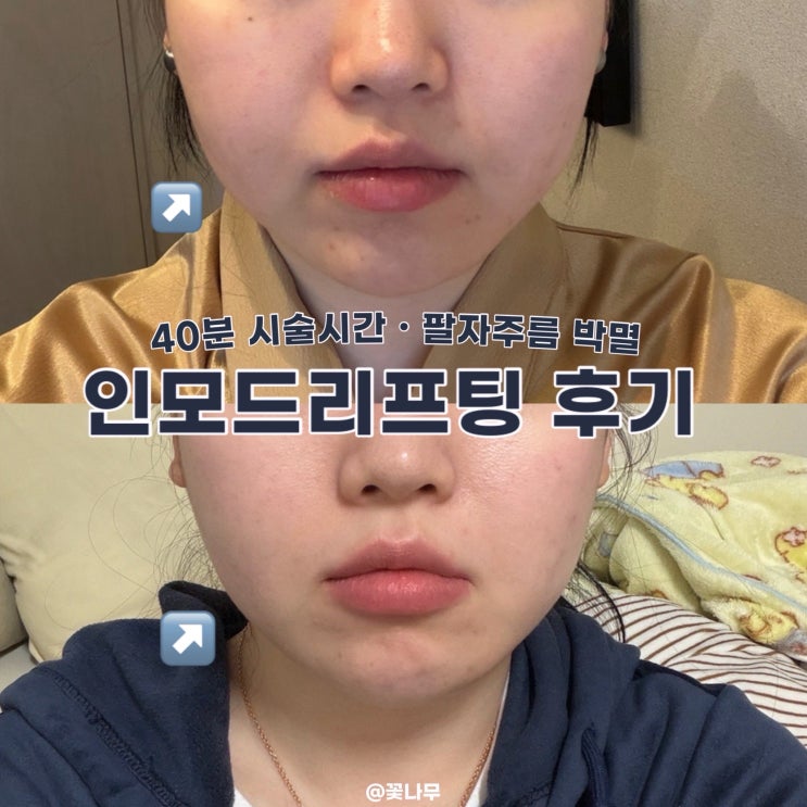  인모드리프팅 FX포마 꼼꼼하게 40분 진행하는 압구정역 피부과 전후 비교 후기