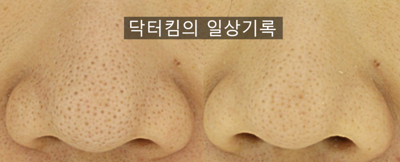 코모공 줄이는 법, 축소 시술, 레이저 치료 [by 피부과 전문의 닥터킴]