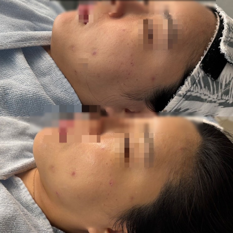  건조피부관리 모공관리 효과 많이 봤던 세멘시트 찐후기:한끗에스테틱