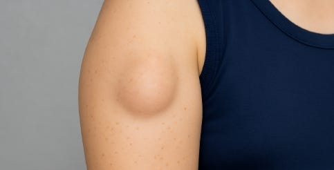 지방종 핀홀법 수술 하는 병원 리스트 (외과 성형외과) 서울 인천 대구 부산