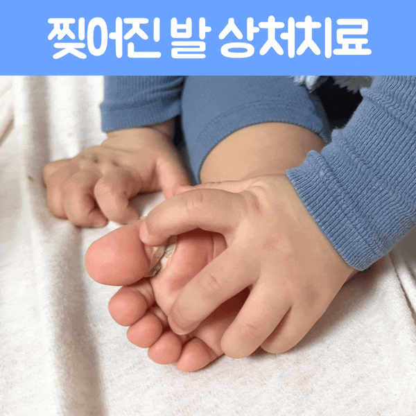 돌아기 발가락 피부 찢어짐으로 급히 찾은 홍제역 피부과