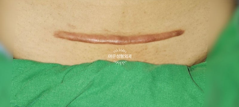 제왕절개 수술 후 켈로이드, 보험 기준은? (흉터 실손보험 실비보험 서울 강동구 아문성형외....