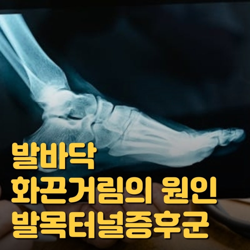 발바닥 화끈거림의 원인, 발목터널증후군 증상과 치료법