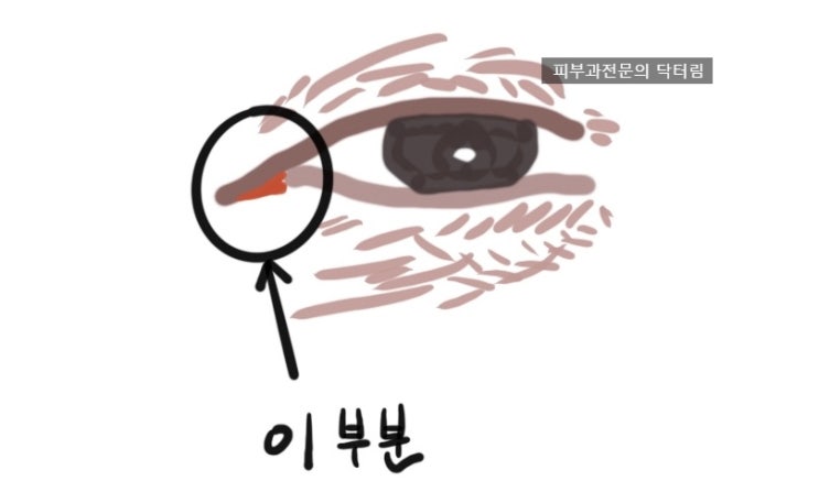 아이써마지 부작용으로 오해받은 2가지 케이스 - 피부과전문의 닥터림