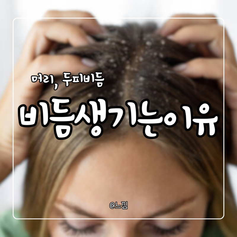 비듬생기는이유 머리 두피 비듬 없애는 방법
