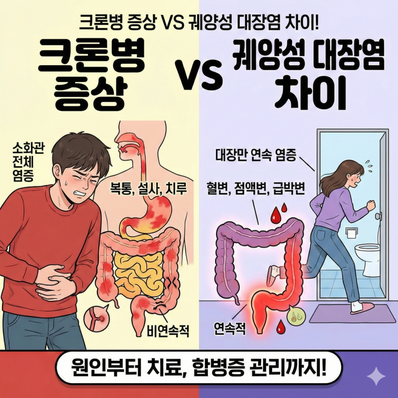 크론병 증상 vs 궤양성 대장염 차이 비교! 원인부터 치료법, 수술 후 합병증 관리법