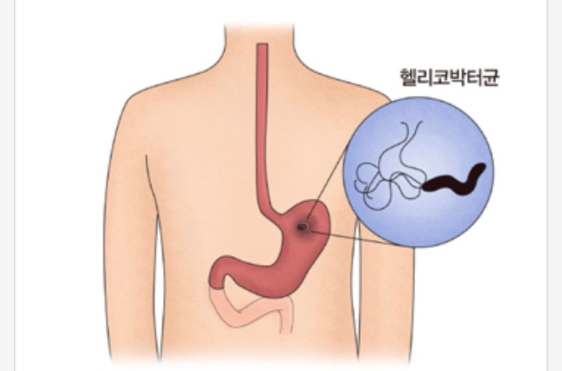 위내시경 헬리코박터균 양성 나왔다면? 위 건강 관리 방법 & 위 점막 영양제 추천