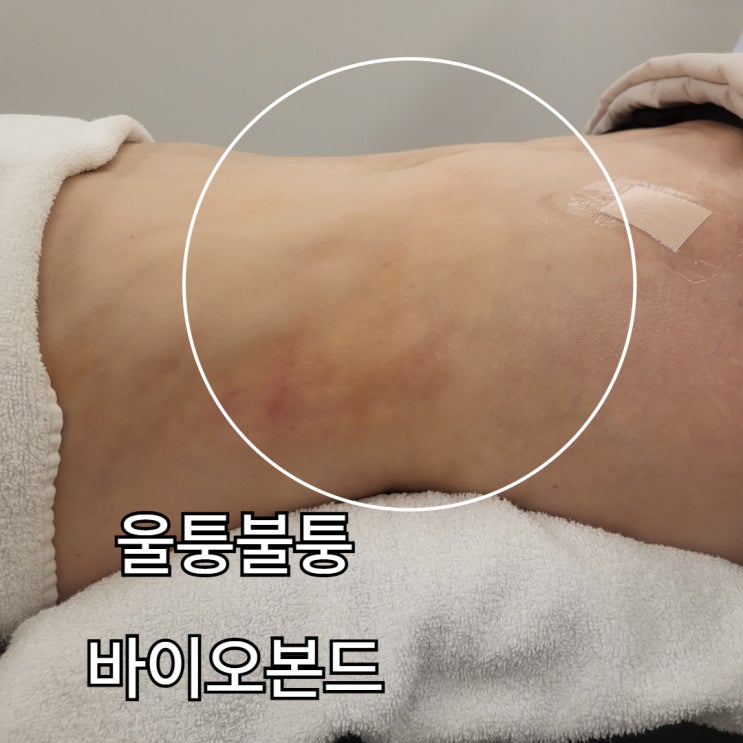  지방흡입 바이오본드 관리는 언제 시작해야 할까?
