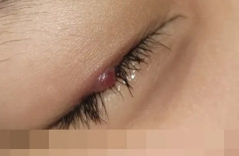 초등 남아 콩다래끼 치료방법, 회복기간, 치료 기간, 낫는기간