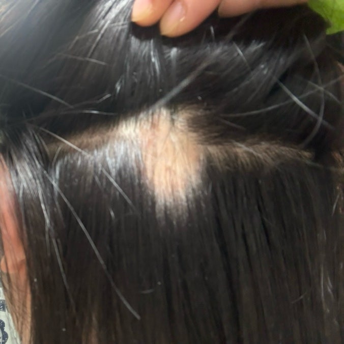원형탈모 초기 , 주사 맞고 일주일차 / 원형탈모 어떻게 관리해야 할까 ?
