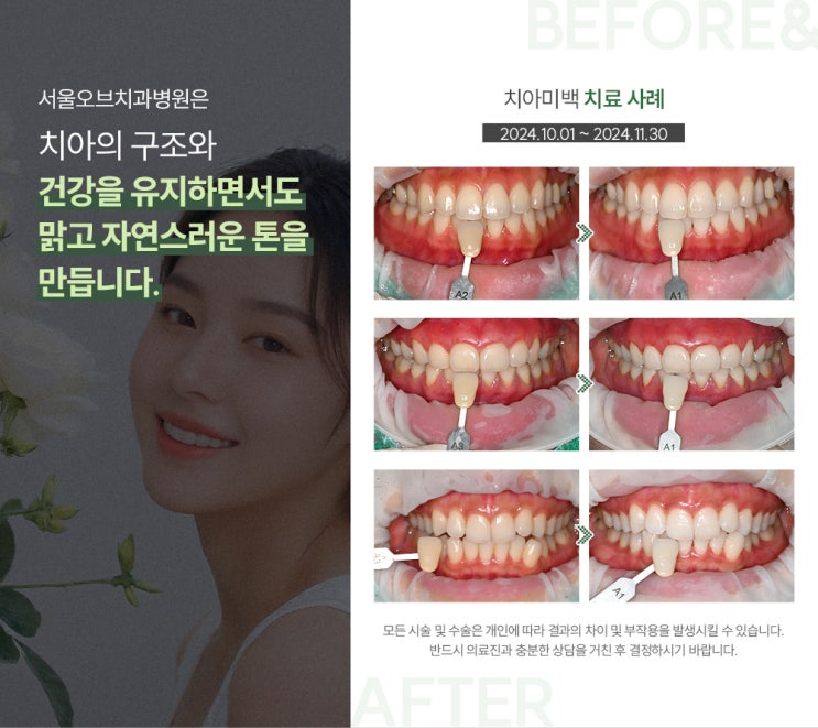  잠실 치아미백, 하루만에 효과 볼 수 있을까요?