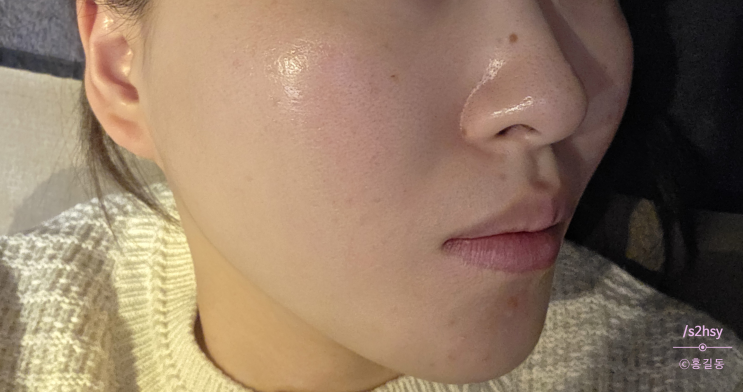  청담피부과 고우리스킨부스터 후기 (쥬베룩 결절, 엠보, 통증, 가격)