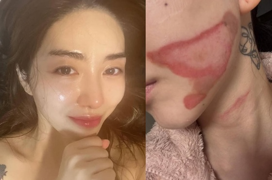 “예뻐지려다 화상이라니…” AOA 권민아 피부과 시술 부작용 고백, 슈링크 리프팅 괜찮은 걸까?(권민아 인스타그램 주소)