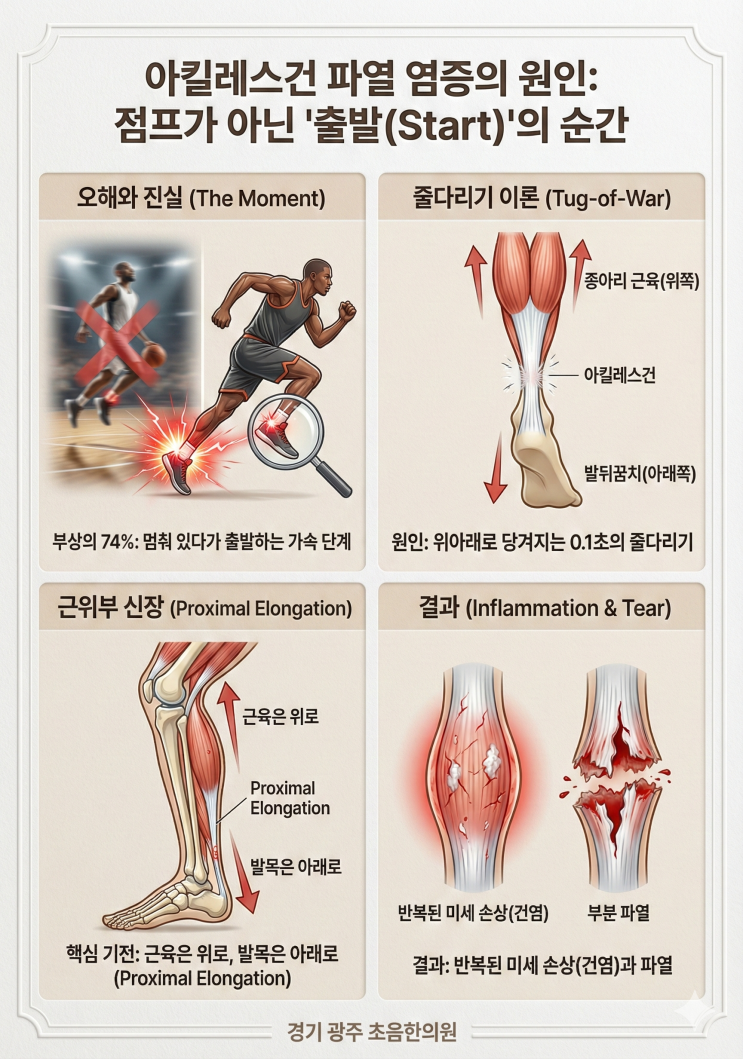  아킬레스건 염증부터 파열까지 : 왜 생기고 어떻게 치료해야할까요?(2026 최신 논문 분석)