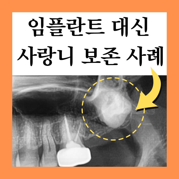  노원교정치과추천, 임플란트 대신 사랑니 매복치 살린 사례