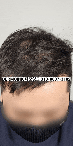  안양 두피 페인팅 후기, 만족도 높은 곳은 뭐가 다를까 솔직 정리