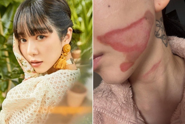 권민아 사주, 슈링크 리프팅 후 심재성 2도 화상