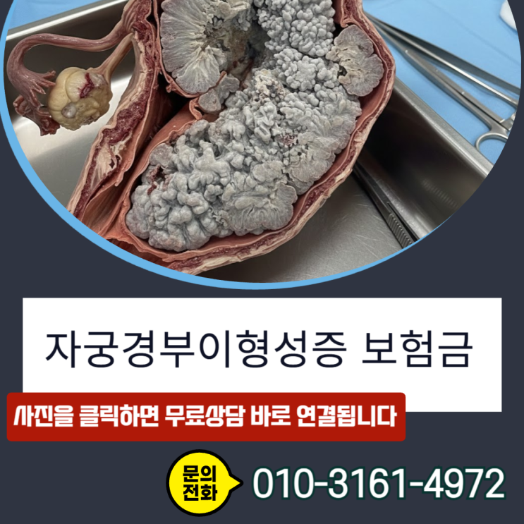  자궁경부이형성증 보험금, N87.2 코드라도 제자리암 전액 수령하는 실무 노하우