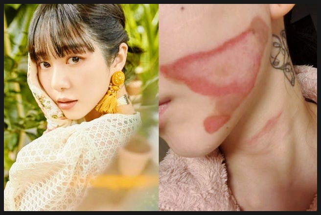  슈링크 600샷이 부른 참사… 권민아 얼굴이 뜯겨나갔다? "가해자가 부러워진다" 씁쓸한 속사정!