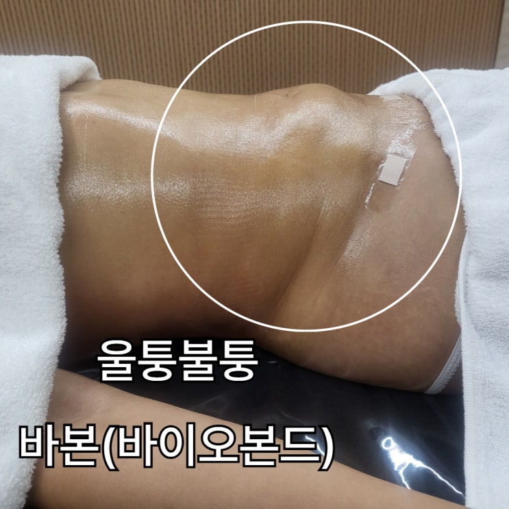  지방흡입 관리는 왜 필요할까요? 바이오본드 회복 단계 정리!