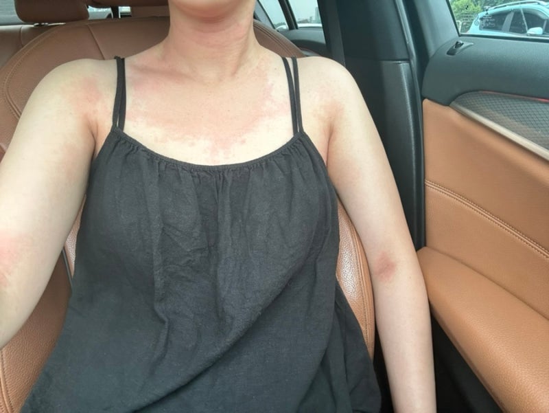 면역력 떨어질 때마다 올라오는 두드러기 2달 넘게 안 낫던 만성두드러기, 결국 이렇게 해결....