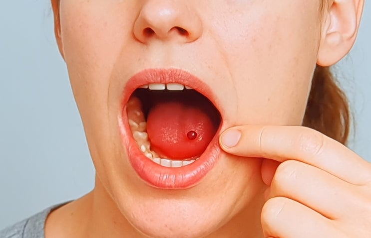  입안이 헐었을때 치료 방법? 입안 헐음 자가 관리