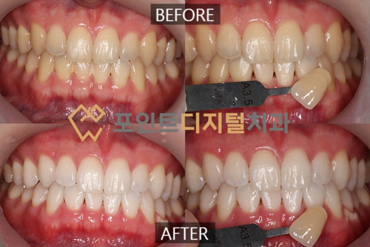 [탕정치과]  쉐이드 가이드 없이 촬영한 치아미백 사진은 신뢰도가 낮습니다. / 천안 아산 불당 배방