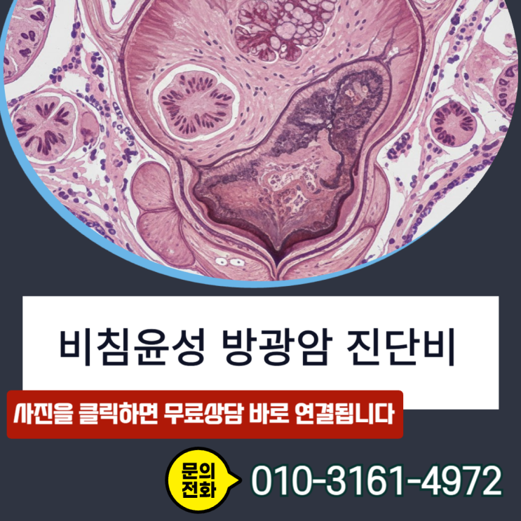  비침윤성 방광암 진단비, C67 코드 받고도 소액암 취급? 전액 수령을 위한 손해사정사 핵심 전략