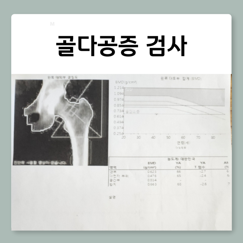골다공증 검사비용 수치 실비 후기
