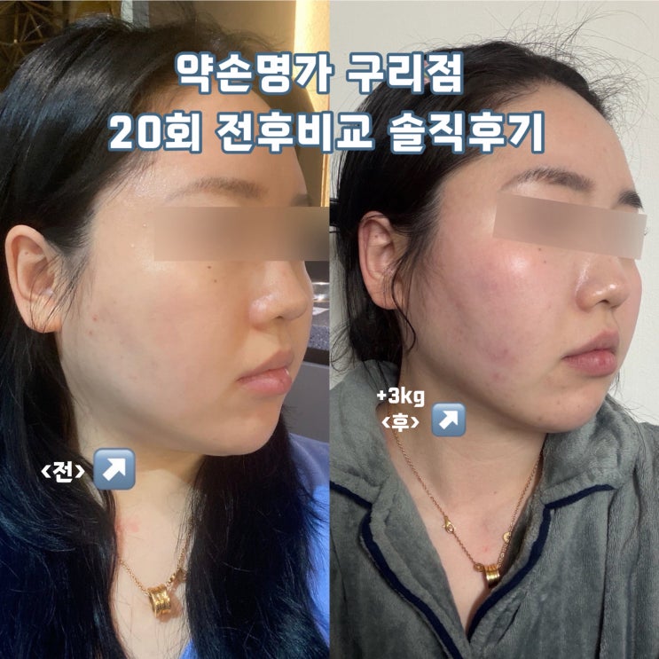  구리약손명가 내돈내산 맞춤관리A 20회 전후비교 후기 | 처음이랑 얼마나 달라졌을까?