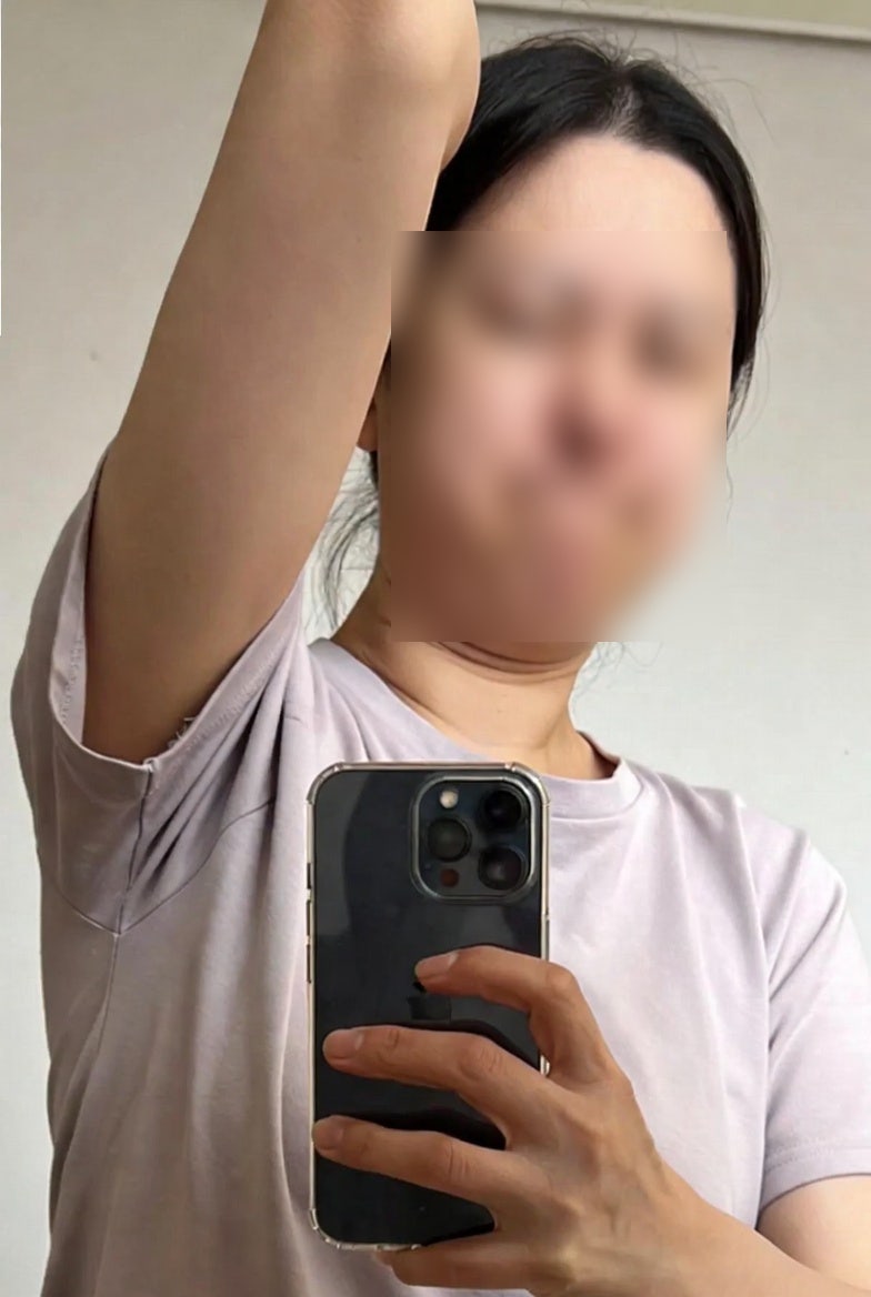 맘모톰 수술 후기, 수술 후 관리가 더 중요했던 이유
