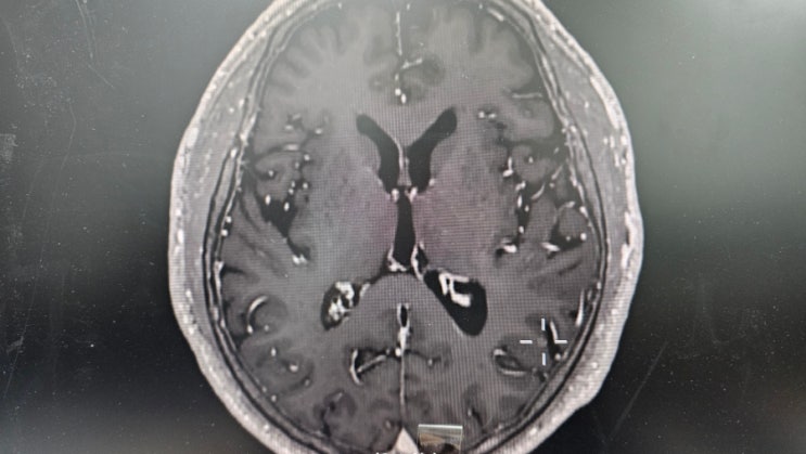  뇌 CT 머리 MRI 차이? 뇌 MRI 와 MRA 뭐가 다를까?