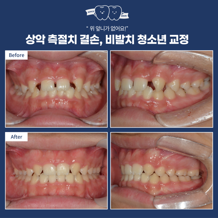  하남 교정, 위 앞니 결손(앞니 영구치 결손)시 어떻게 교정 치료하는게 좋을까?꼭 임플란트를 해야 할까요?
