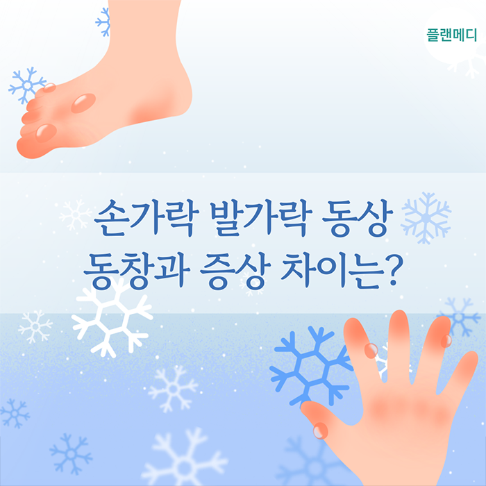 손가락 발가락 동상 동창 차이! 증상 단계별로 응급처치 알아보자