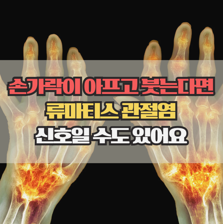  손가락이 붓고 아프다면? 류마티스 관절염 증상 체크
