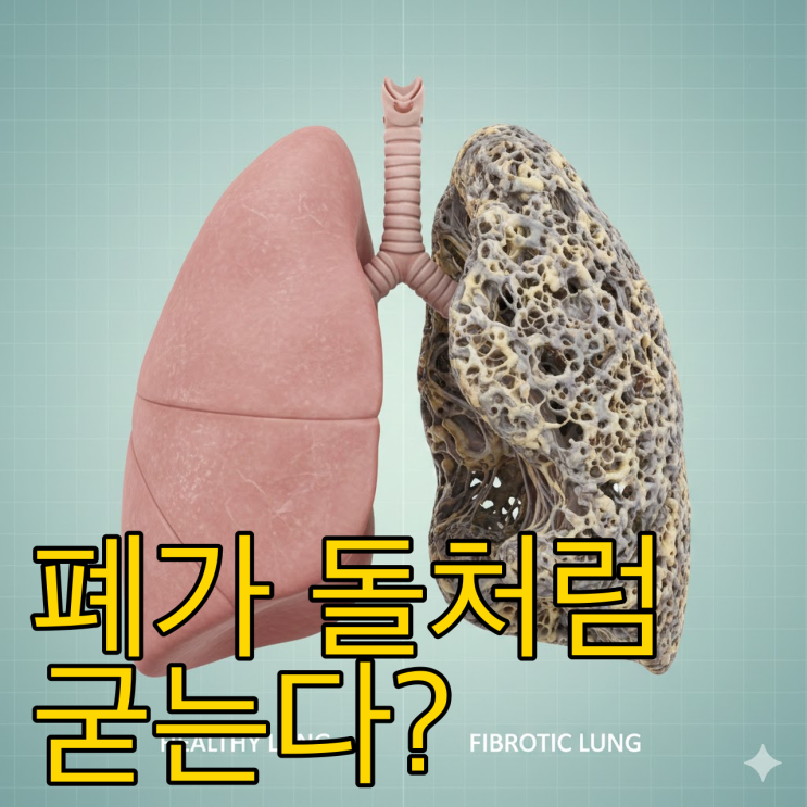  폐가 돌처럼 굳는다? 폐섬유증 초기증상과 생존율 높이는 치료법