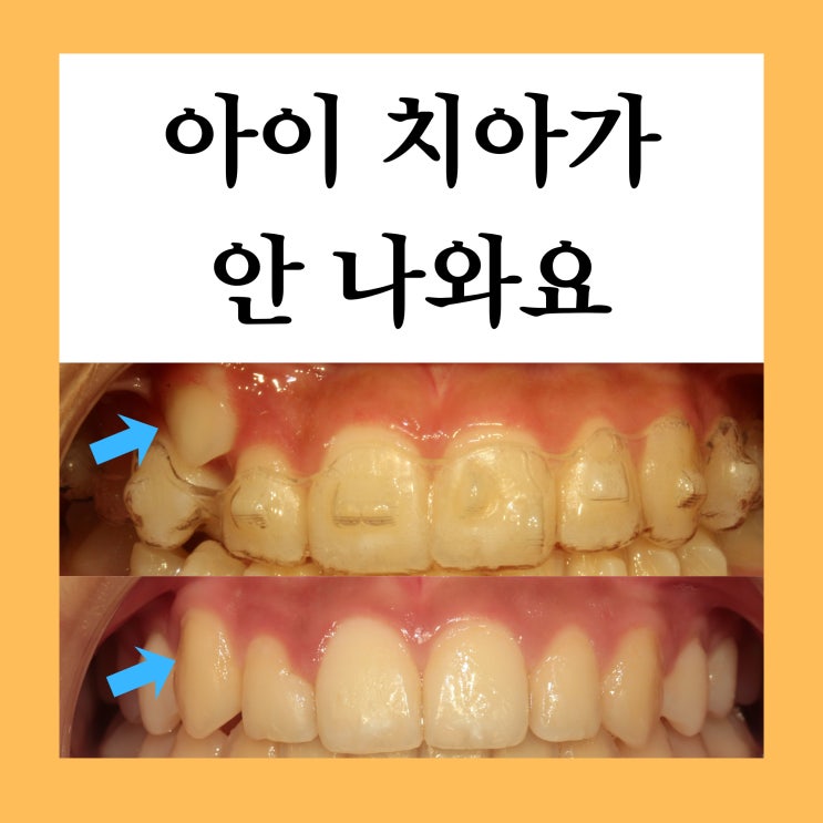  창동치아교정, 아이 앞니 매복 1차 교정으로 끝낼 수 있을까요? (인비절라인 퍼스트)
