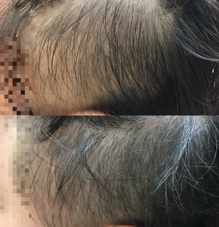  [부산사상 르네시떼 미용실] 탈모 고민 끝! 정밀 두피 관리부터 마법 같은 커버 스타일 펌까지