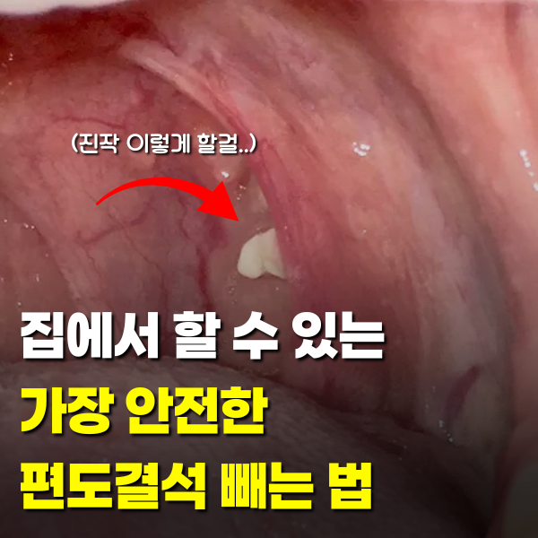 "진작 이렇게 할 걸.." 집에서 안전하고 쉽게 편도결석 빼는 법(+병원 제거 비용)