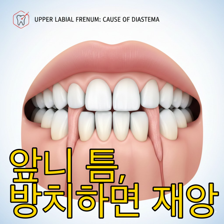  앞니 벌어짐의 주범, 순소대 절제술 타이밍과 팩트 체크
