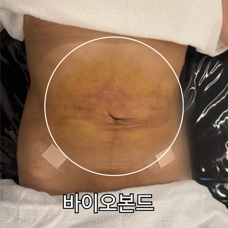  복부 지방흡입 바이오본드, 언제 가장 심해질까요? 관리 전후 변화