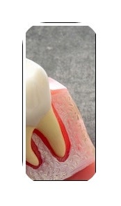 김포 구래치과 임플란트 재수술 즉시 확인해봐야