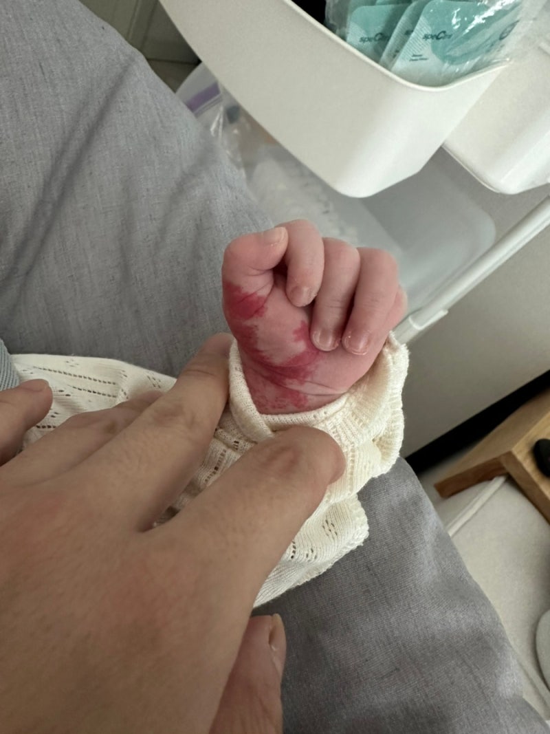 신생아 혈관종 부산병원